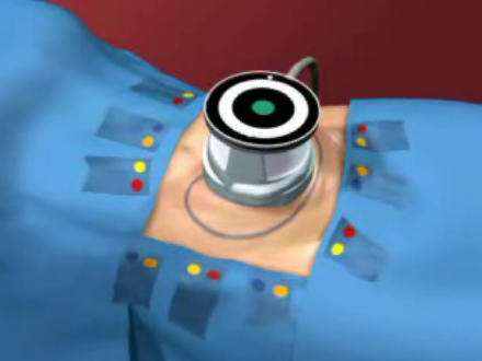 Liposuction Out - Ultrashape In
